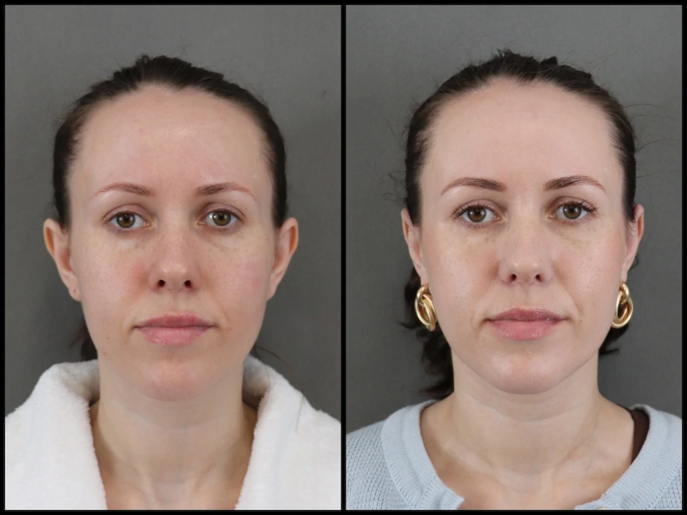 Эстетическая отопластика — результат #107, до и после