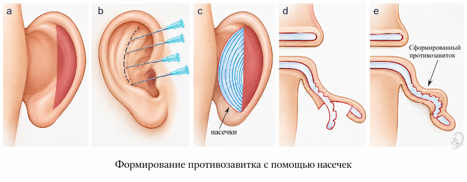Формирование противозавитка с помощью насечек хряща