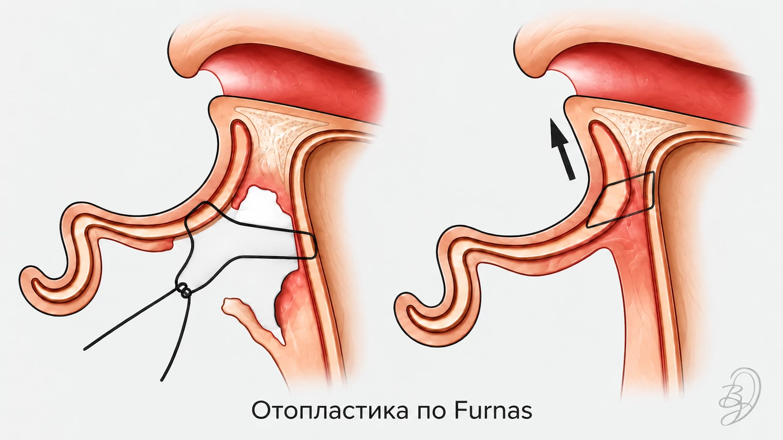 Отопластика по Фурнасу: фиксация ушной чаши швом