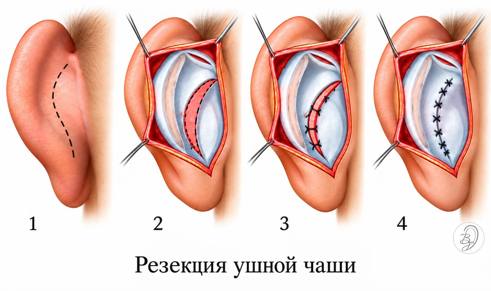 Резекция ушной чаши: этапы операции